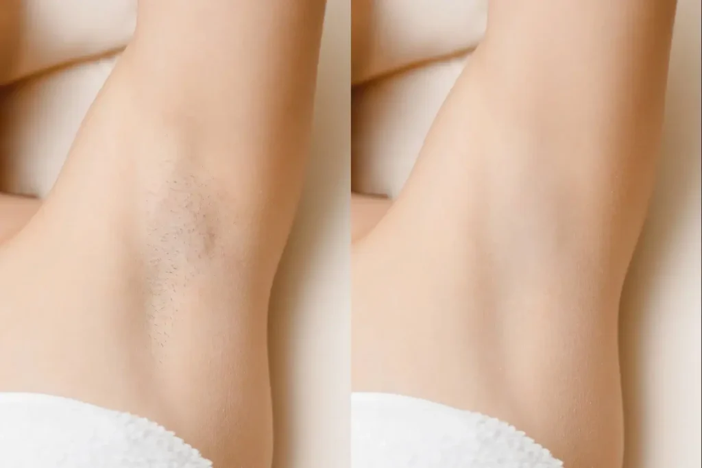 udalenie-diodnym-lazerom (1)